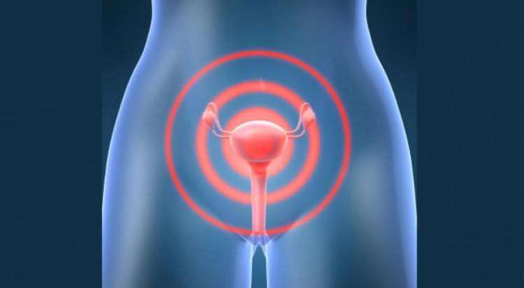 mioma uterino centro avançado endometriose